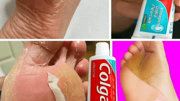 Guard Your Smile: Natural Ways to Prevent Cavities