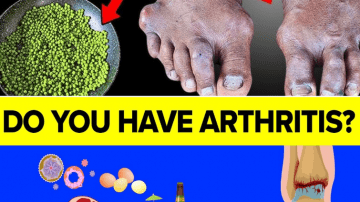 5 Foods to Stop Kidney Stones in Their Tracks