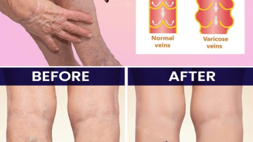 Do These 10 Things to Protect Your Kidneys for Life