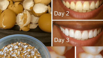 How To Get Rid of Nail Fungus Using Garlic: A Natural Remedy With Hidden Potential